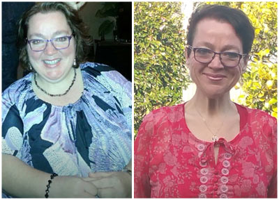 Jen's Gastric Sleeve Surgery has happy results