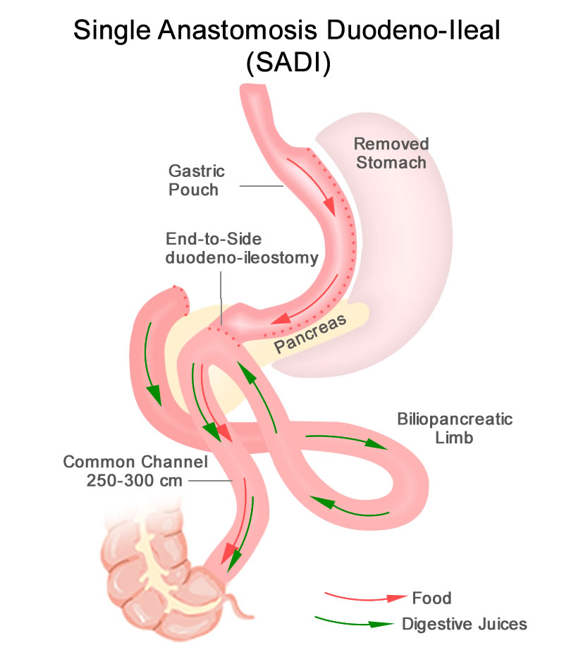 Single Anastomosis Duodenal-Ileal Bypass with Sleeve Gastrectomy (SADI-S)
